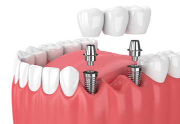 Multiple missing teeth