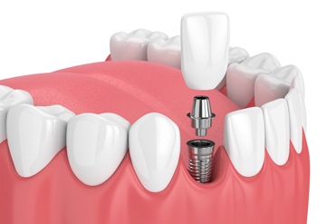Single tooth implants