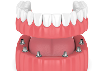 Teeth-in-a-day